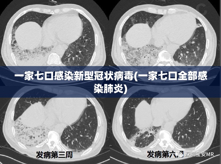 一家七口感染新型冠状病毒(一家七口全部感染肺炎)