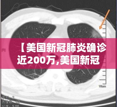 【美国新冠肺炎确诊近200万,美国新冠肺炎确诊突破33万】 【美国新冠肺炎确诊近200万,美国新冠肺炎确诊突破33万】