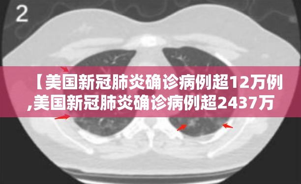 【美国新冠肺炎确诊病例超12万例,美国新冠肺炎确诊病例超2437万例】 【美国新冠肺炎确诊病例超12万例,美国新冠肺炎确诊病例超2437万例】