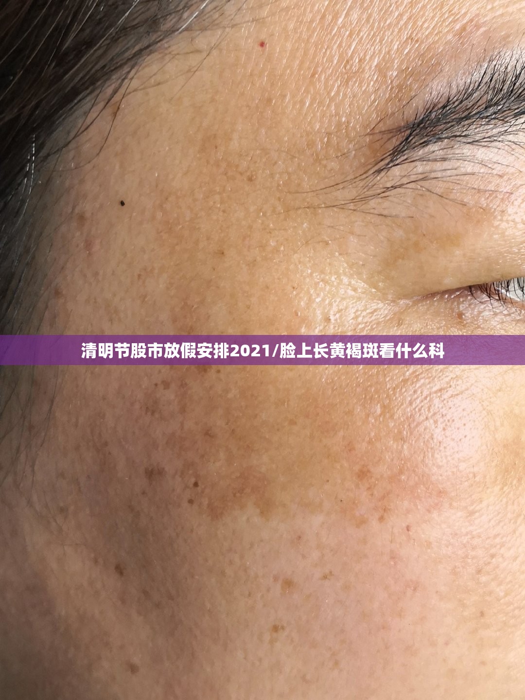 清明节股市放假安排2021/脸上长黄褐斑看什么科 清明节股市放假安排2021/脸上长黄褐斑看什么科