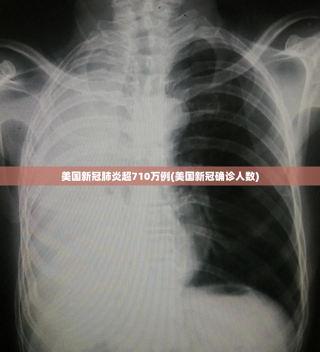 美国新冠肺炎超710万例(美国新冠确诊人数) 美国新冠肺炎超710万例(美国新冠确诊人数)