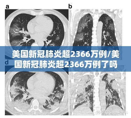 美国新冠肺炎超2366万例/美国新冠肺炎超2366万例了吗 美国新冠肺炎超2366万例/美国新冠肺炎超2366万例了吗